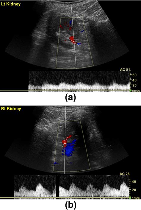 Imaging And Management Of Atherosclerotic Renal Artery Stenosis