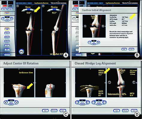 Computer Assisted Closed Wedge High Tibial Osteotomy The Navigation