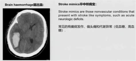 急性缺血性脑卒中的影像学评估 知乎