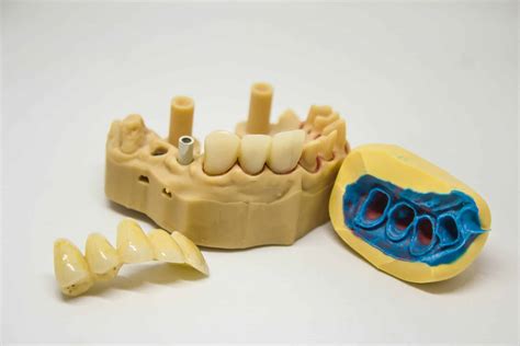 What is the procedure for a tooth extraction?