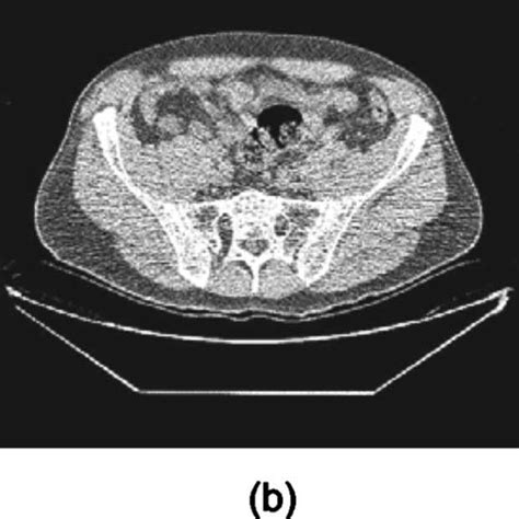 Representative Ct Image Artifacts A A Shoulder Phantom Image With