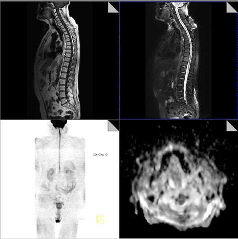 Figure 1 From Whole Body Diffusion Weighted Mri Wb Dwi In The