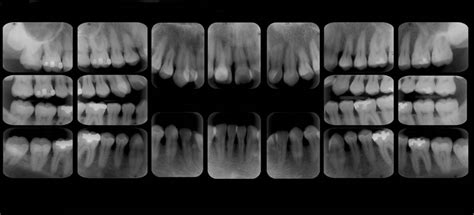 Periapical Dr Julio Tojo