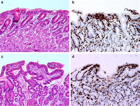 Gastric Body And Antrum Biopsies Demonstrating Lymphocytic Gastritis In Download Scientific