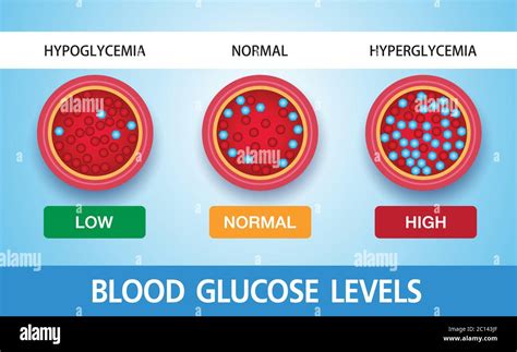 Hiperglucemia azúcar en sangre alta y diabetes la obesidad es una