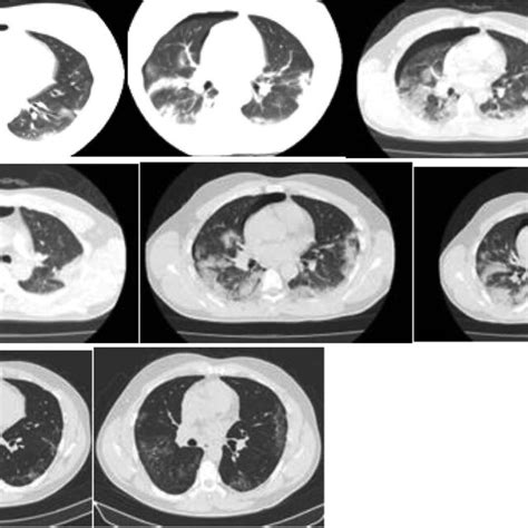 Axial Section Of 1 Patient Showing A Right Low Abundance Pneumothorax