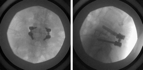 Extreme Lateral Interbody Fusion Xlif A Novel Surgical Technique For