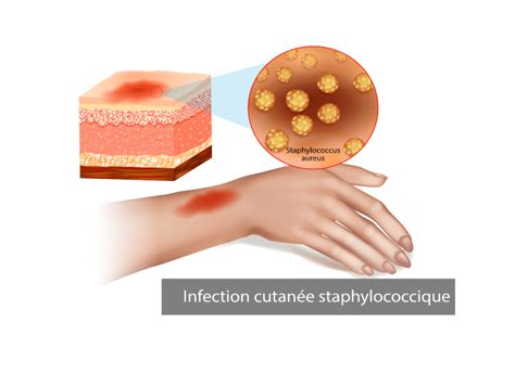 Staphylocoque Dor D Finition Sympt Mes Et Traitements