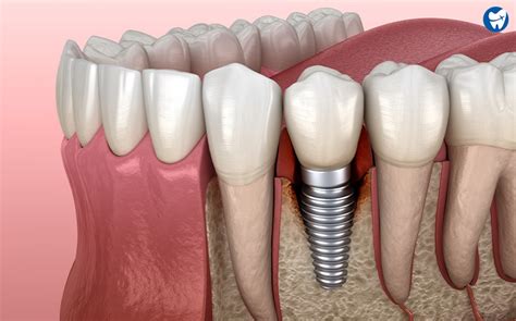 Dental Implant Problems Potential Complications Implant Care Faqs