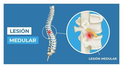 Qu Tipos De Lesiones Medulares Hay Cl Nica Uner