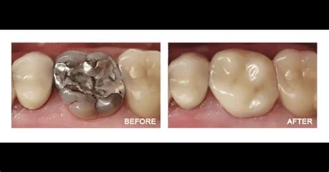 One Day Crowns Cerec Crown Dental Restoration