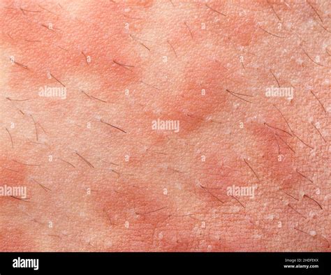 Urticaria Hives Hi Res Stock Photography And Images Alamy