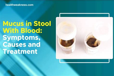 Mucus In Stool With Blood: Symptoms, Causes, Treatment 2023