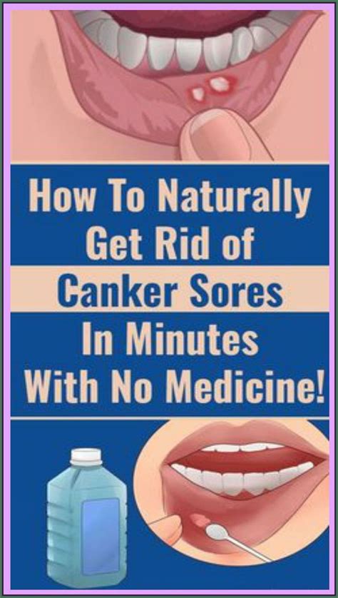 How To Get Rid Of Canker Sores Artofit