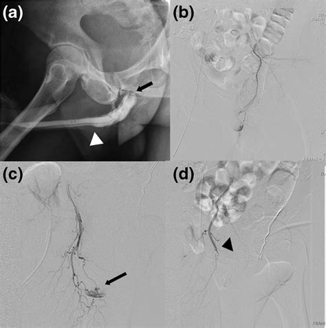 Retrograde Urethrography Showing Disruption At The Bulbomembranous