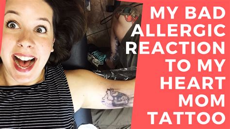 Details 126 Allergic Reaction To Tattoo Best Vn