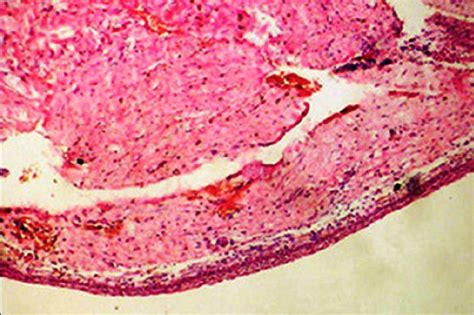 Eruption Cyst Histology