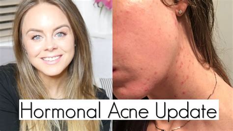 Hormonal Acne Update I Curing Hormonal Acne Naturally Without Accutane