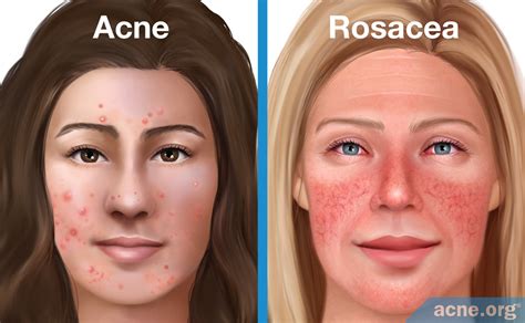 Acne Rosacea Vs Acne Vulgaris