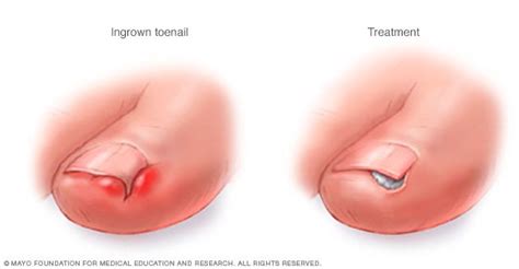 Ingrown Toenails Disease Reference Guide Drugs