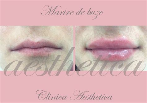 Before After Aesthetica Constanta Dr Corina Cazacu Beauty And