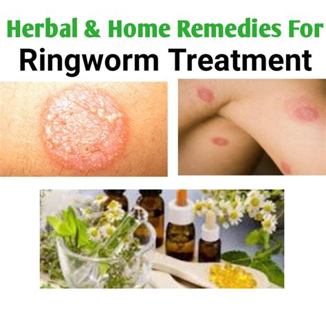 Best Medications For Ringworm Treatment - Public Health