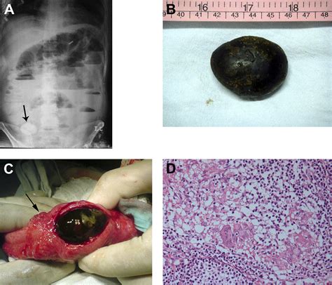 Enterolith A Diagnostic Clue For Intestinal Stricture Clinical