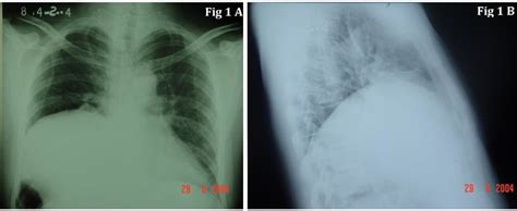 Preoperative PA Chest Radiograph A And Lateral View B Showing