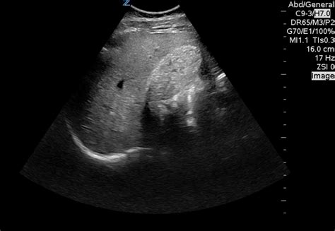 What’s causing his RUQ pain? | Hennepin Ultrasound