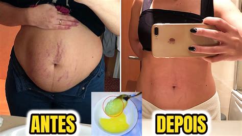 Como Tirar Estrias Da Barriga Como Tirar Estrias Da Perna NATURAL OU