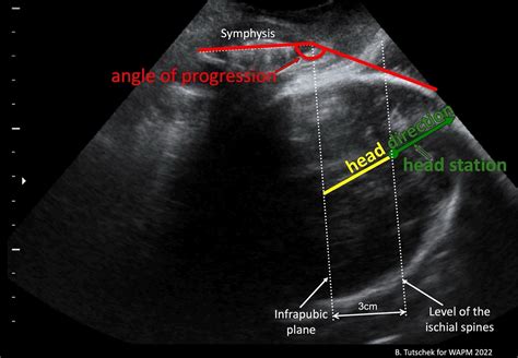 Ultrasound In Labor Clinical Practice Guideline And Recommendation By