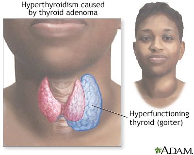 Hyperthyroidism (Overactive Thyroid) - Symptoms and Causes