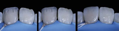 Direct Composite Veneers A Guide For Correct Layering Technique