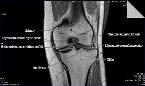 La Gaceta Del Técnico De Rayos Protocolo De Rodilla En Tomografía Por