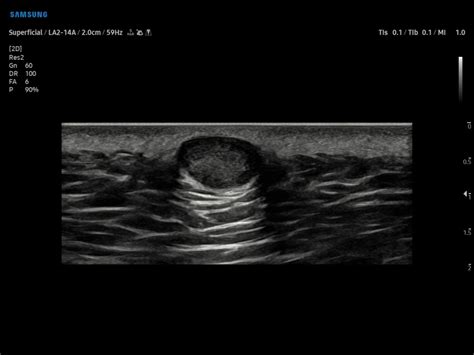 Ultrasound Images • Lipoma B Mode Echogramm №901