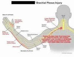 Brachial Plexus Lesions in Hyderabad | ID: 17433213955