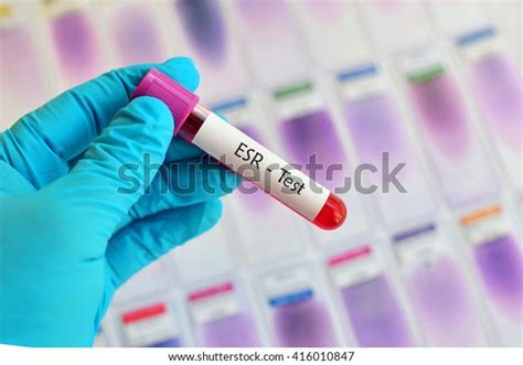 Blood Sample Erythrocyte Sedimentation Rate Esr Stock Photo 416010847 ...