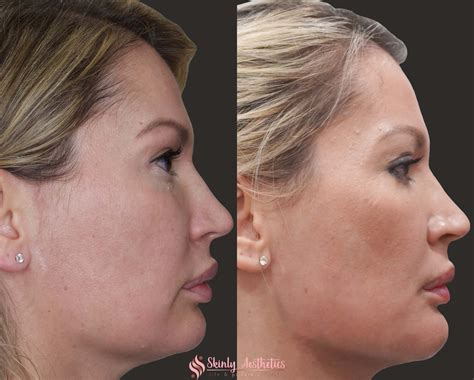 Chiseled Jaw Before And After