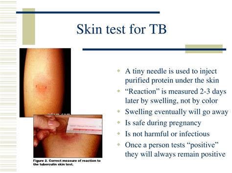 Ppt Tuberculosis Powerpoint Presentation Free Download Id 1099305