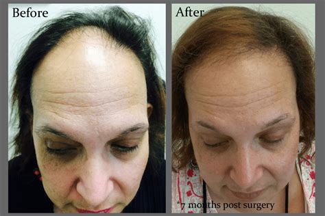 Women's Hair Loss and Hair Restoration for Women