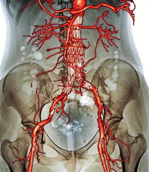 Stent In Aortic Aneurysm Photograph By Zephyr Science Photo Library