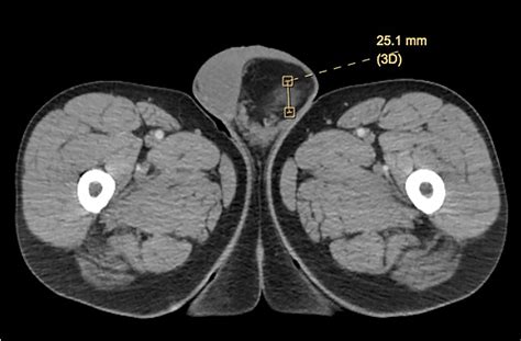 Frontiers Spindle Cell Lipoma Of The Spermatic Cord A Case Presentation And Literature Review