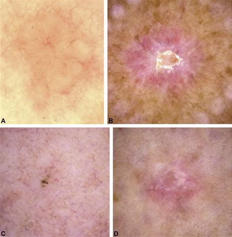 Basal Cell Carcinoma Journal Of The American Academy Of Dermatology