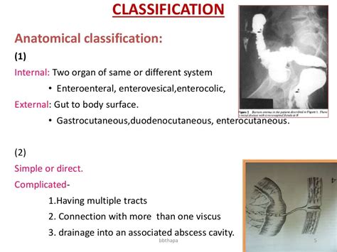 Management Of Enterocutaneous Fistula