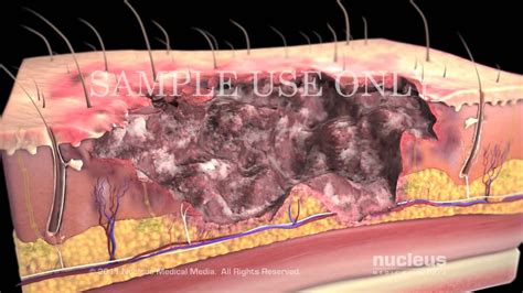 Burns Classification And Treatment Youtube