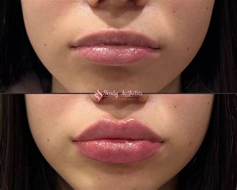 Russian Lip Filler Before And After Results Skinly Aesthetics