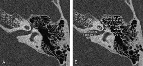 Infranuclear Facial Palsy Importance Of Imaging The Genicul