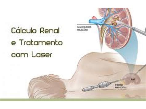 TRATAMENTO DE CÁLCULO RENAL EM CAMPO GRANDE RJ Rj