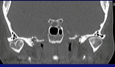 CDS836 Imaging Of The TMJ Flashcards Quizlet