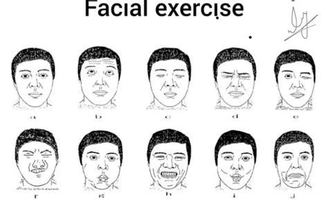 Physiolair Bell S Palsy And Elctro Stimulation Effect